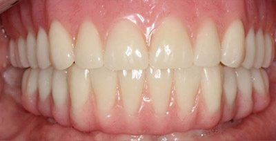 Smile Gallery - After Treatment - Full Mouth Reconstruction