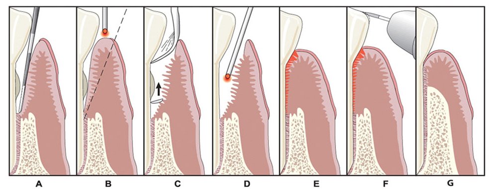 Lanap procedure - Longview, TX