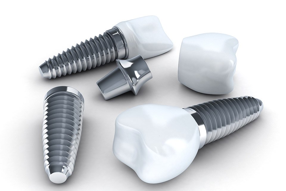 dental implants - Texarkana, TX