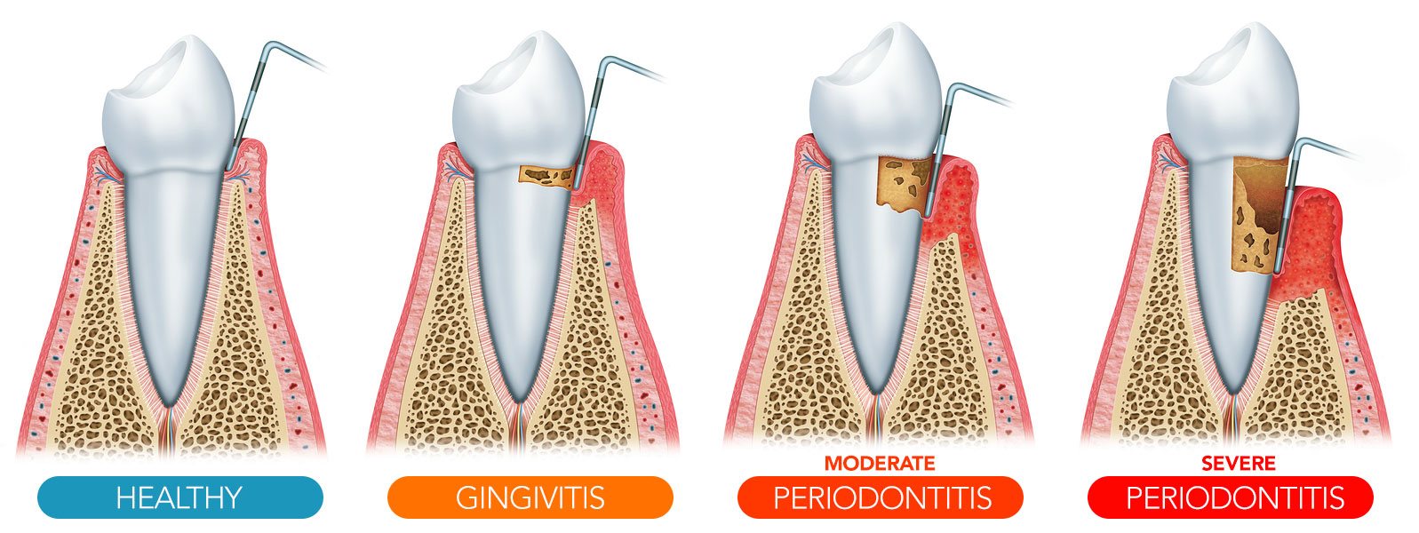 gum disease stages - Longview, TX