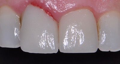 Smile Gallery - After Treatment - Gum Disease