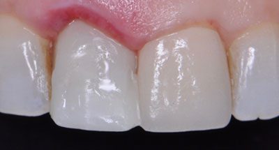 Smile Gallery - Before Treatment - Gum Disease