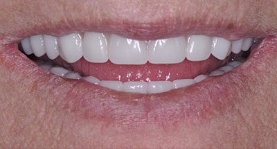 Smile Gallery - After Treatment - Dental Implants