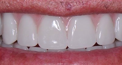 Smile Gallery - After Treatment - Dental Implants