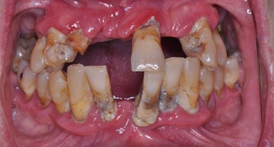 Smile Gallery - Before Treatment - Full Arch Dental Implants