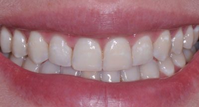 Smile Gallery - After Treatment - Crown Lengthening