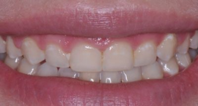 Smile Gallery - Before Treatment - Crown Lengthening