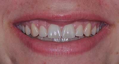 Smile Gallery - After Treatment - Crown Lengthening