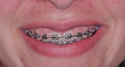 Smile Gallery - Before Treatment - Crown Lengthening
