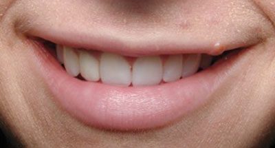 Smile Gallery - After Treatment - Dental Implant