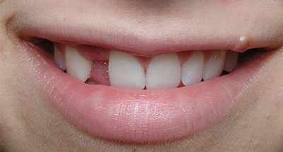 Smile Gallery - Before Treatment - Dental Implant