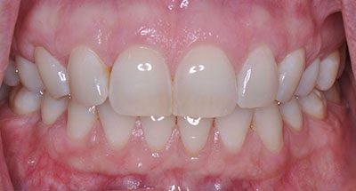 Smile Gallery - After Treatment - Gum Recession 
