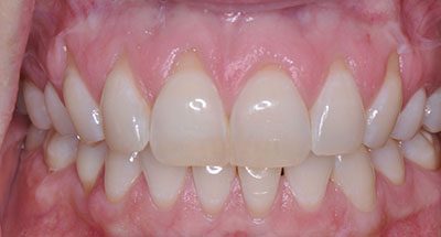 Smile Gallery - Before Treatment - Gum Recession 