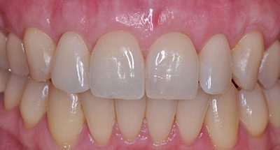Smile Gallery - After Treatment - Gum Recession