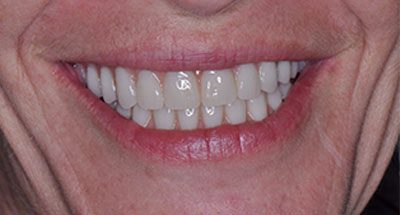 Smile Gallery - After Treatment - Full Mouth Reconstruction