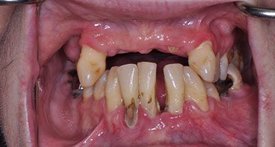 Smile Gallery - Before Treatment - Full Mouth Reconstruction