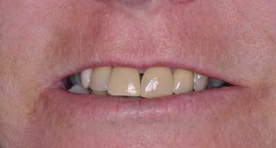 Smile Gallery - Before Treatment - Dental Implants