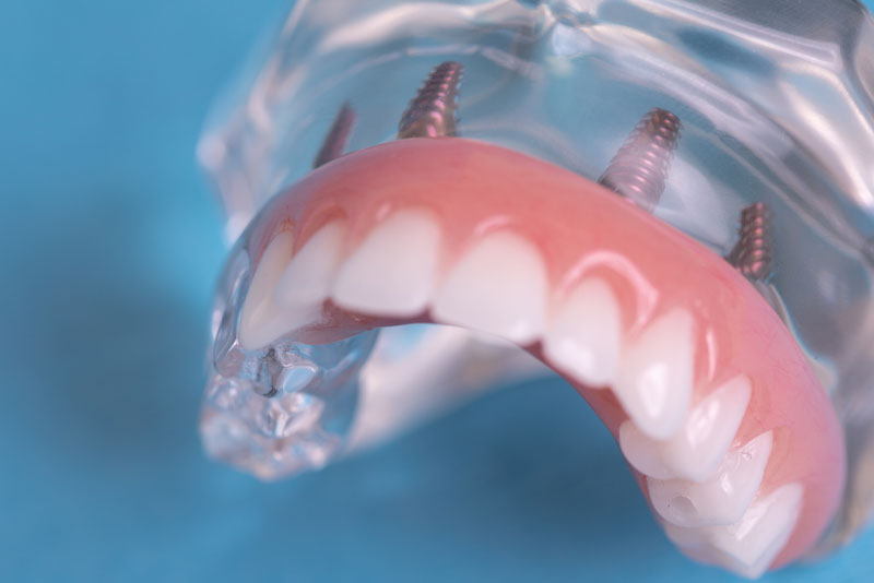 Implant Supported Dentures Model