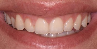 Smile Gallery - After Treatment - Crown Lengthening