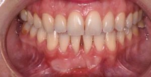 mouth after gingival graft