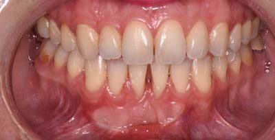 Smile Gallery - After Treatment - Gum Recession
