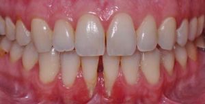 mouth before gingival graft